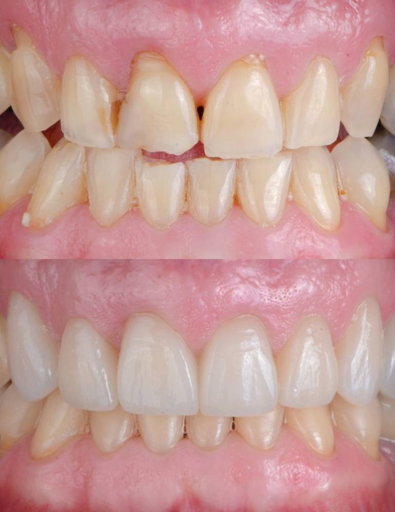 Porcelain & Zirconia crowns in Turkey Costs Medica Smile