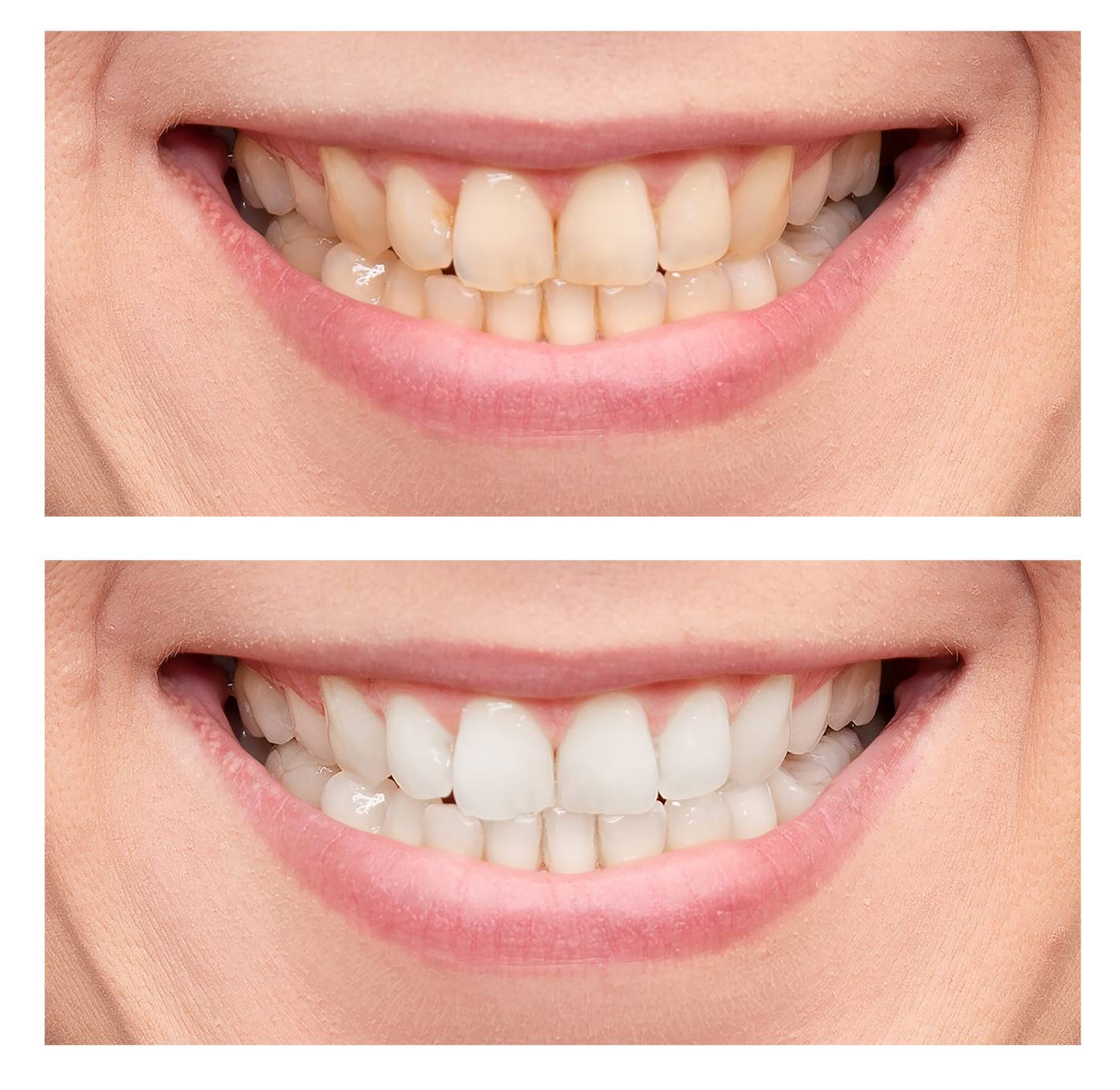 Teeth Whitening in Turkey as an Alternative to Dental Veneers.