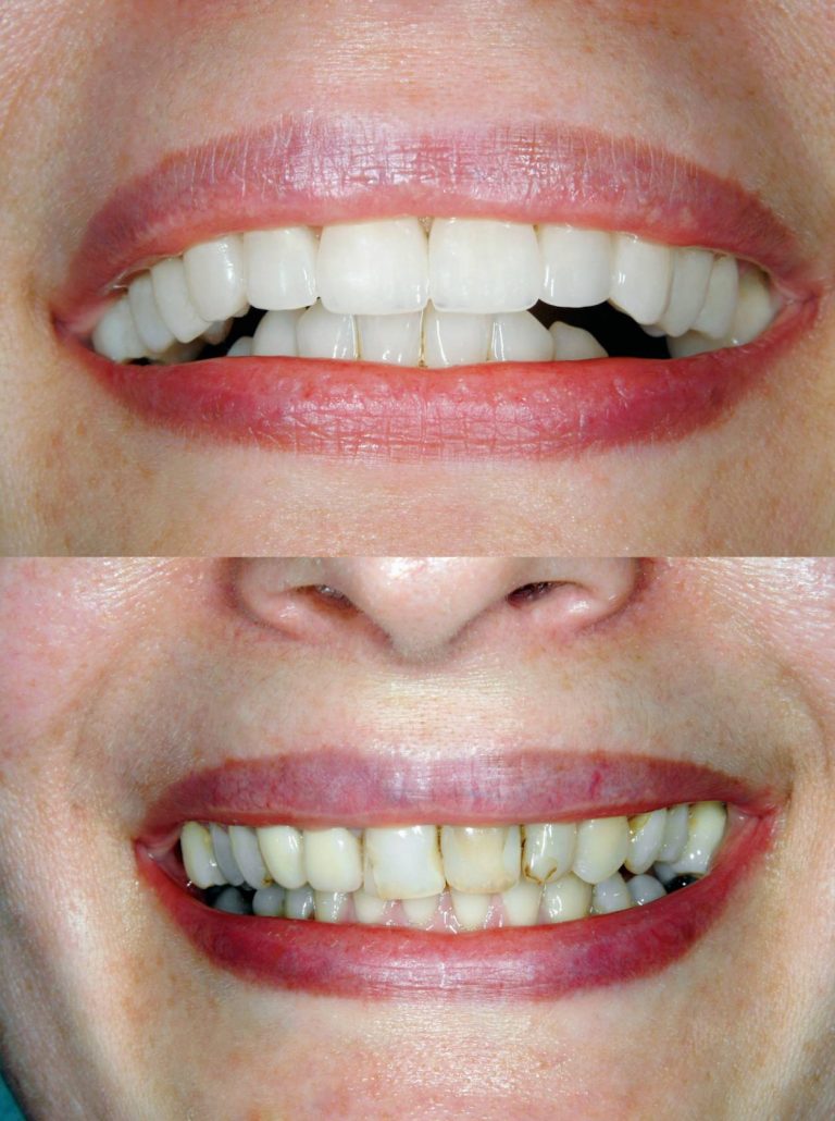 How much does a full set of veneers cost in Turkey?