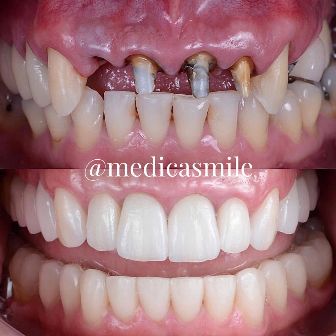 Before and After Full smile makeover