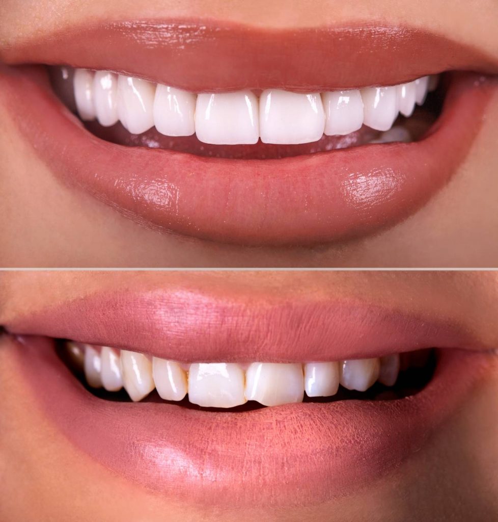 How much does a full set of veneers cost in Turkey?