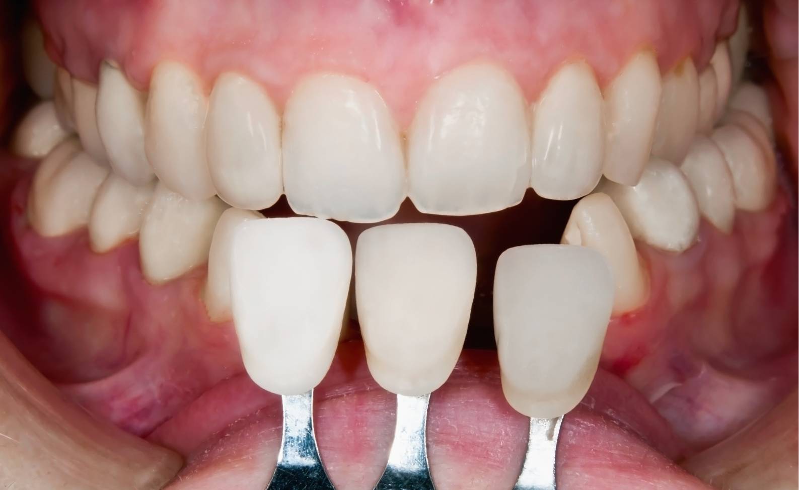 How much does a full set of veneers cost in Turkey?
