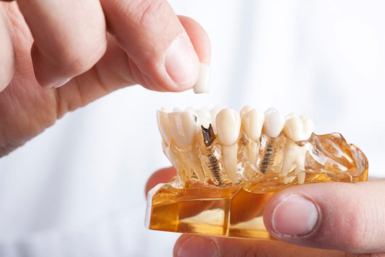 How to Mentally Prepare for Dental Implant Surgery? MedicaSmile