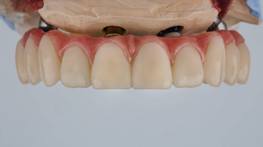Implant-supported bridge