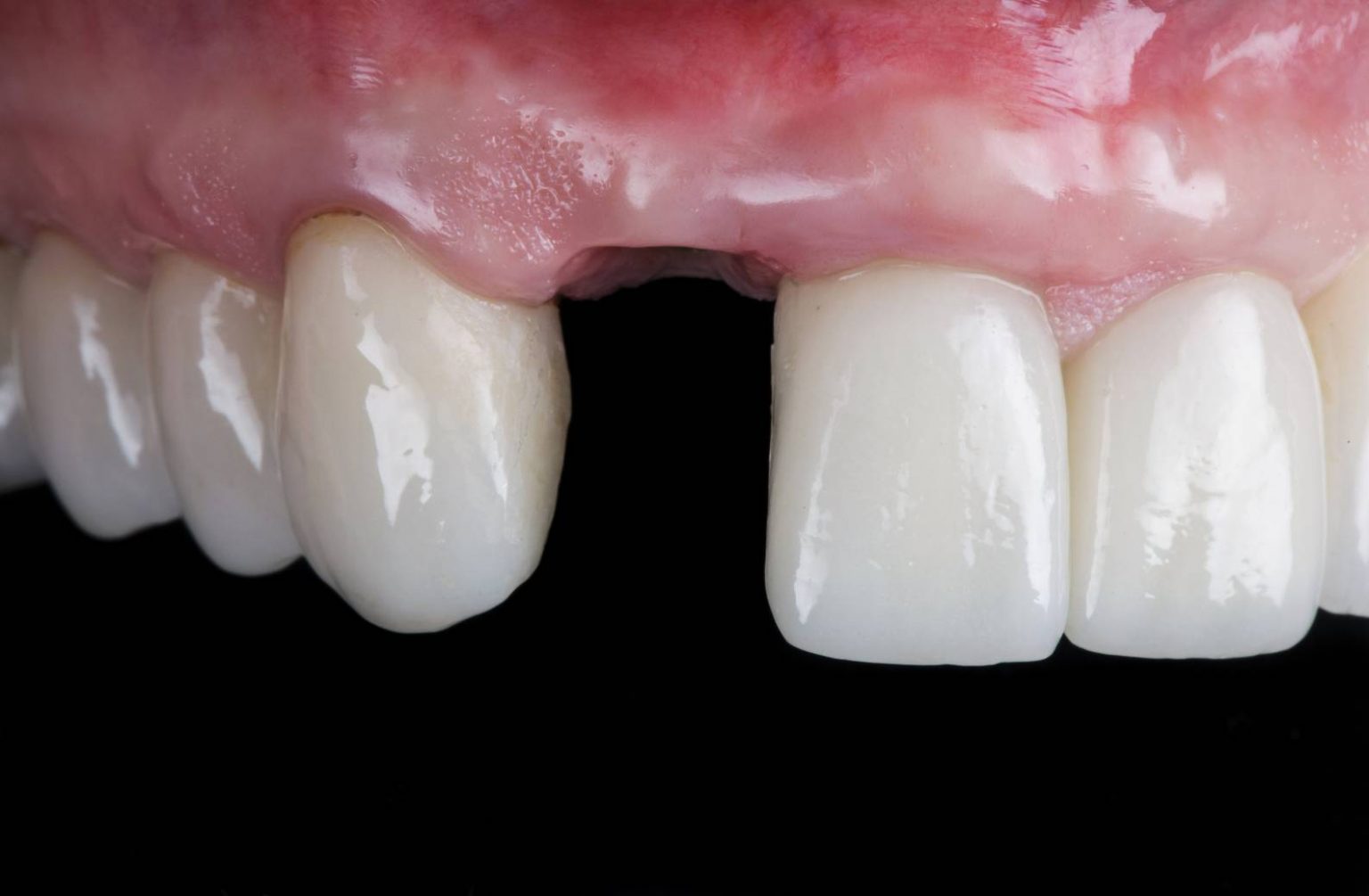 Can a dental implant fall out? MedicaSmile