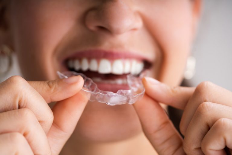 What is a gum shield? MedicaSmile