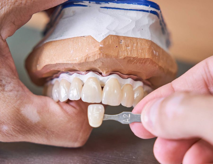 Veneer treatment process in Turkey