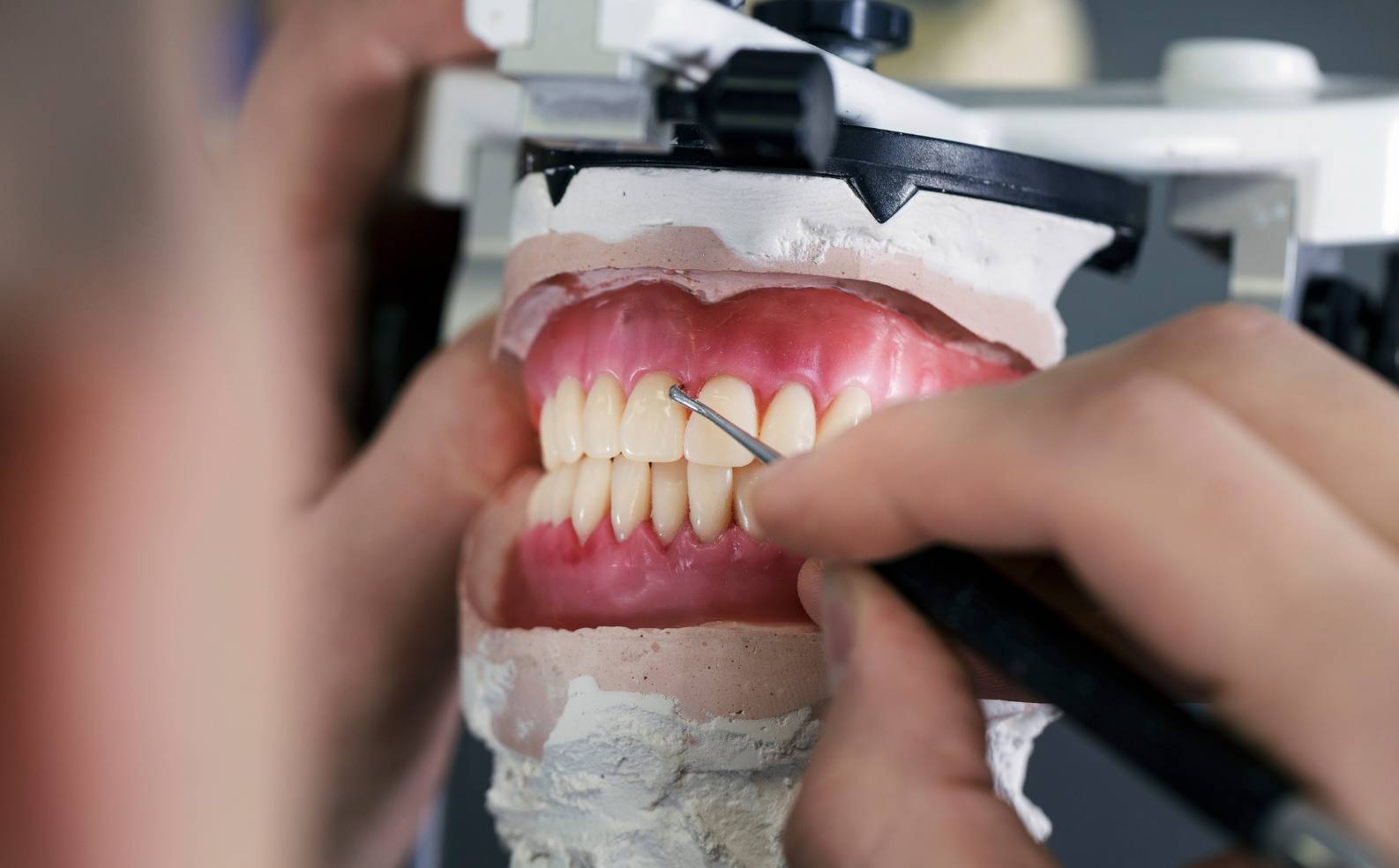 What is gum graft surgery? MedicaSmile