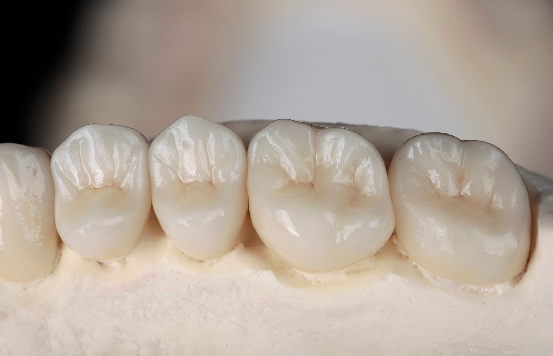 Zirconium Crowns in Turkey