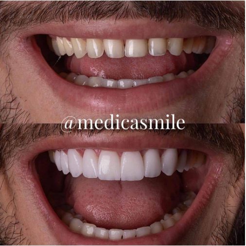 Ceramic Veneers in Turkey