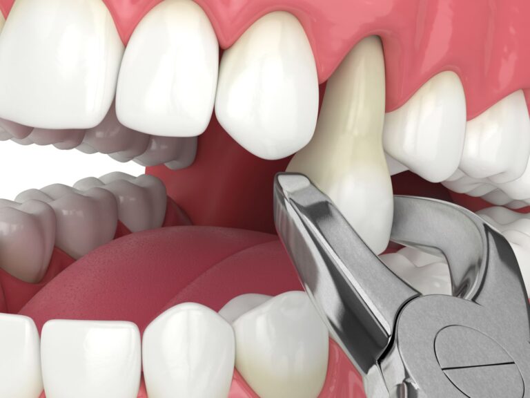What to expect during tooth extraction in Turkey?