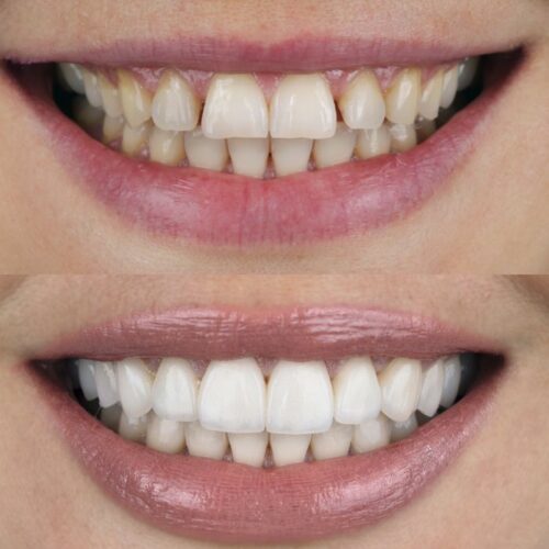 Getting Veneers in Turkey; Prices and Reviews MedicaSmile