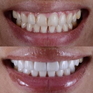 Dental Veneer Before and After