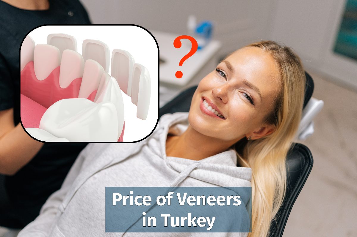 Price of Veneers in Turkey Veneers Cost at MedicaSmile