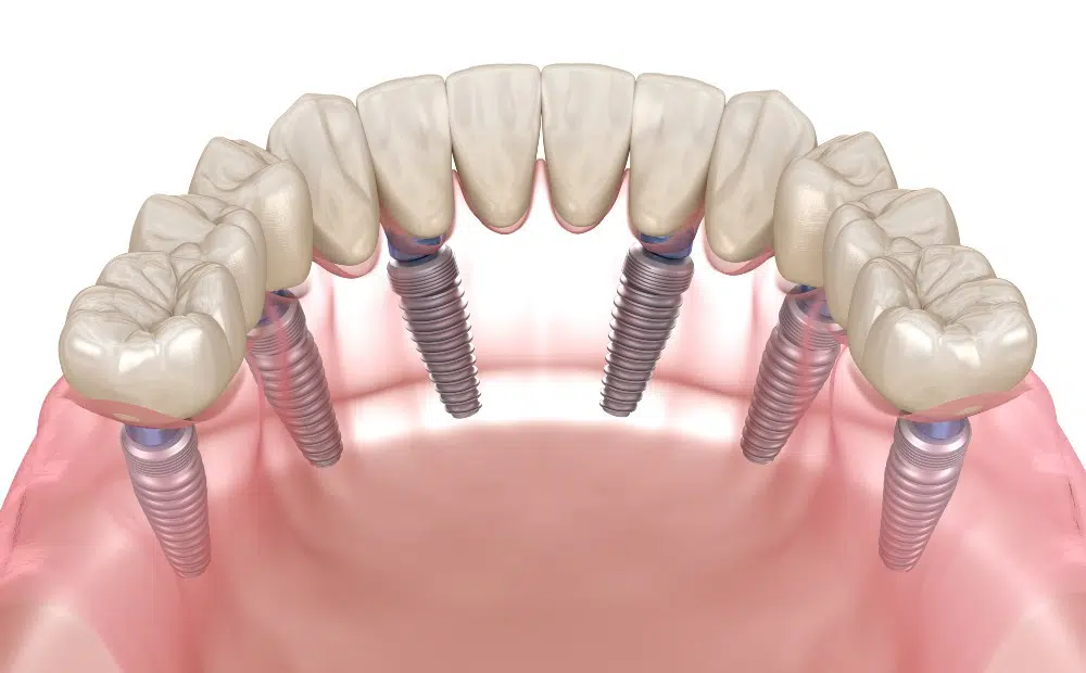 3-on-6 Dental Implants