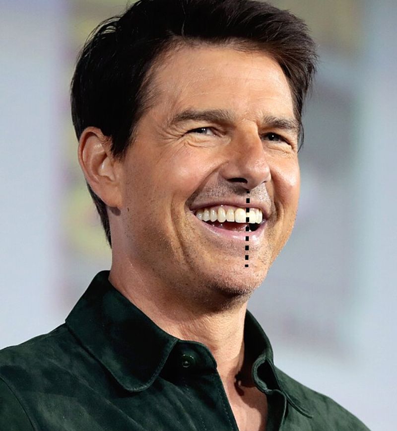 Tom Cruise Teeth Misalignment