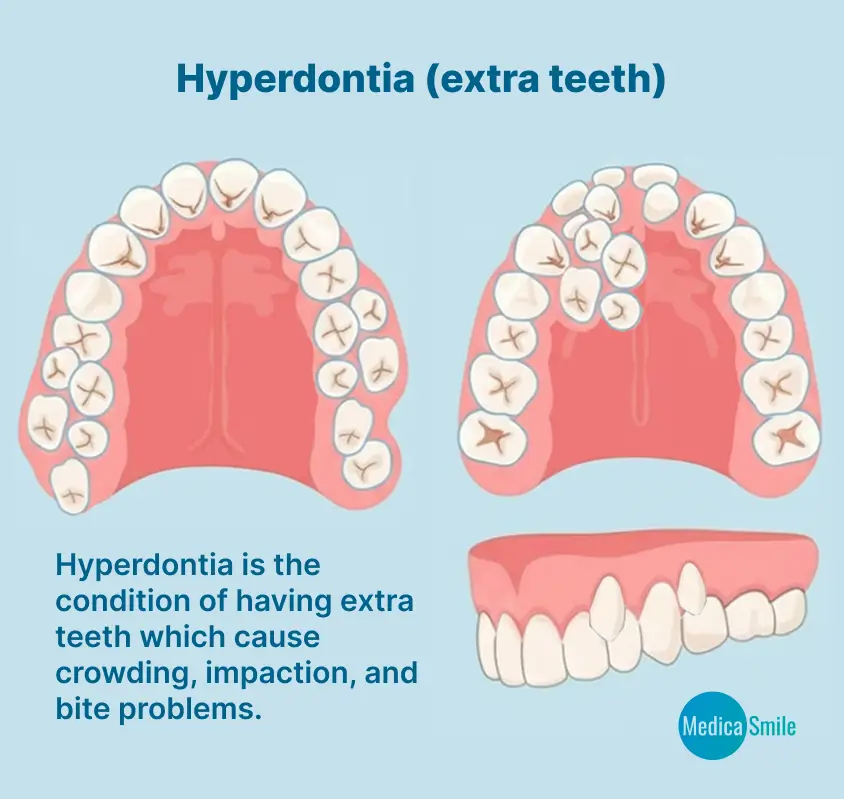 What is hyperdontia