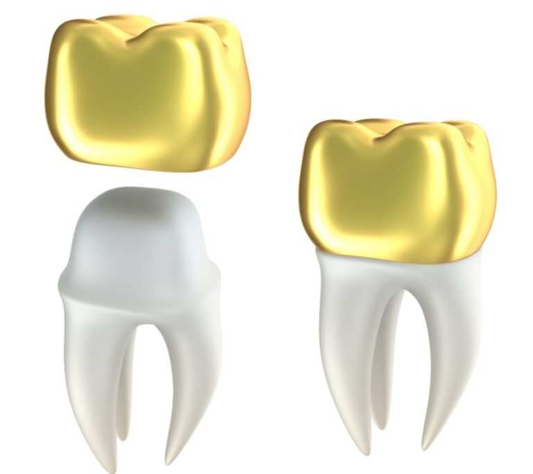 Dental crowns placing