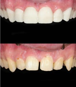 before and after dental crown full veneers