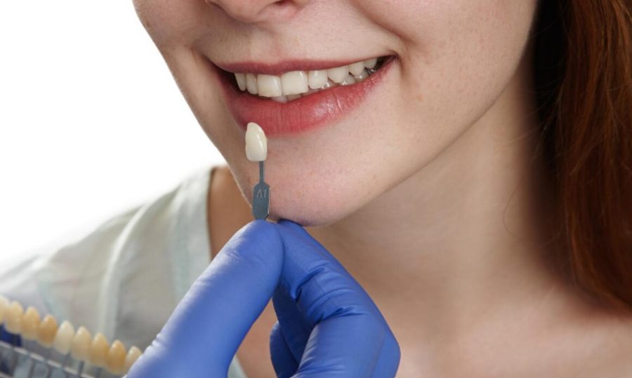 E-Max Veneers