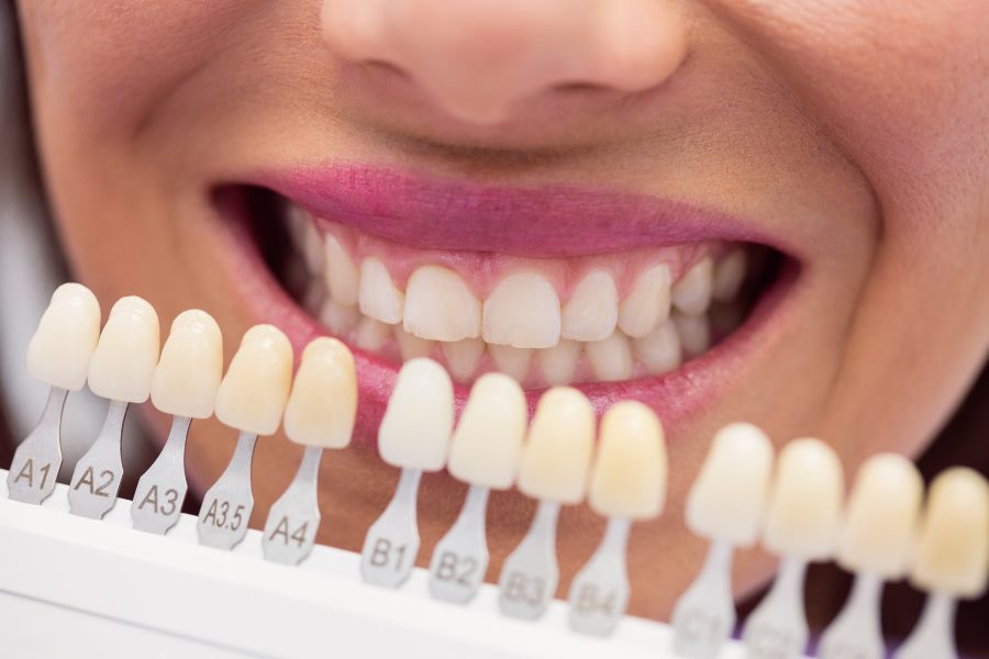 Zirconia veneers